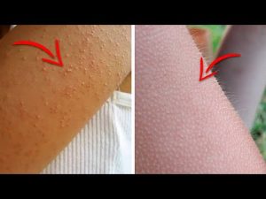 Read more about the article Do You Have Those Tiny Bumps on Your Arms? Here’s What They Mean