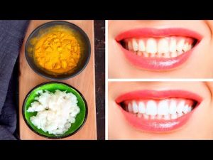 Read more about the article How to Whiten Teeth in a Few Days Using Only 2 Ingredients