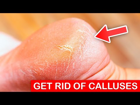 Read more about the article 3 Fast Ways to Get Rid of Calluses