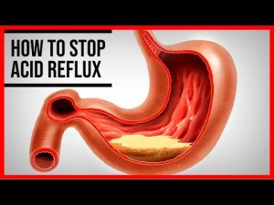 Read more about the article 3 Home Remedies for Acid Reflux That Really Work