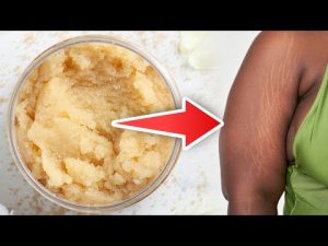 Read more about the article How To Get Rid of Stretch Marks Naturally