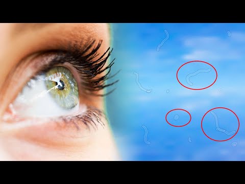 You are currently viewing What are Eye Floaters and How Can it Affect Your Vision