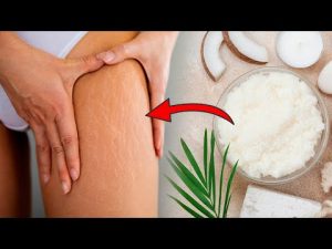 Read more about the article Get Rid of Stretch Marks and Cellulite With This Sugar Scrub Recipe