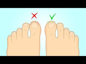 Read more about the article How to Fix Ingrown Toenails Fast at Home