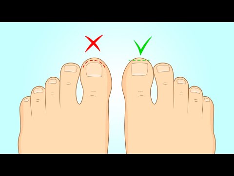 You are currently viewing How to Fix Ingrown Toenails Fast at Home