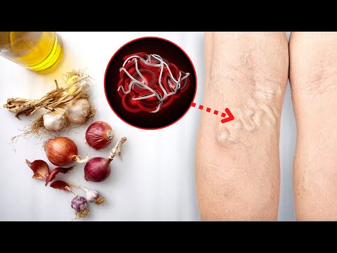 You are currently viewing Eat These “Blood Thinning” Foods To Prevent Stroke and Blood Clots