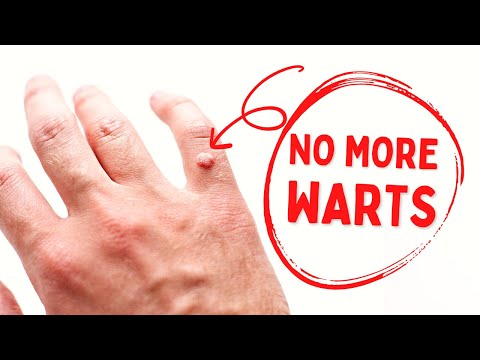 Read more about the article Your Wart Will Fall Off Quickly After Applying This Mixture