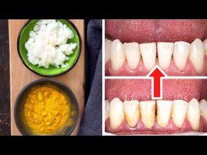 Read more about the article How To Remove Tartar And Plaque From Your Teeth Without A Dentist