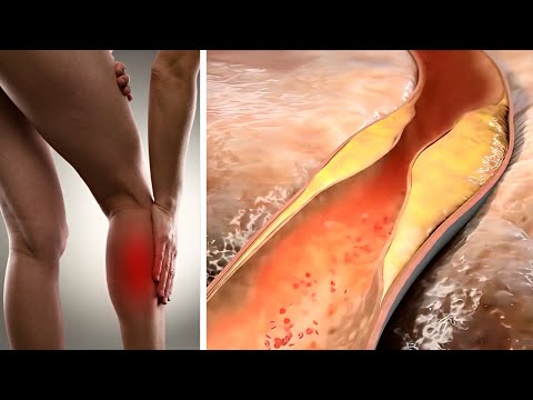 You are currently viewing If You Feel This Kind Of Pain, You May Have High Cholesterol