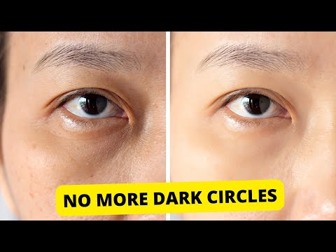 Read more about the article How to Get Rid Of Dark Circles Under The Eyes Fast and Naturally