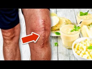 Read more about the article Avoid Knee Surgery with This Delicious Pineapple Smoothie Recipe