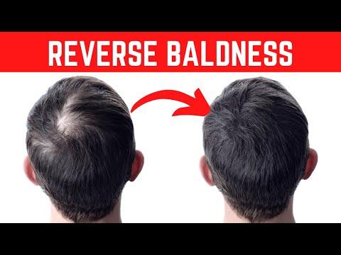 You are currently viewing Science Proves It! This Oil May Reverse Baldness And Hair Loss