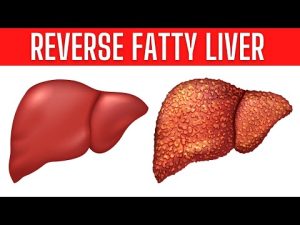 Read more about the article These Home Remedies Can Reverse Fatty Liver Naturally