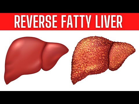 You are currently viewing These Home Remedies Can Reverse Fatty Liver Naturally