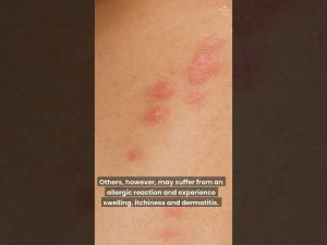 Read more about the article What Bit Me? How To Identify The Most Common Bug Bites #shorts