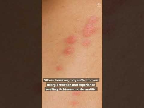 Read more about the article What Bit Me? How To Identify The Most Common Bug Bites #shorts