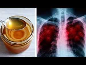 Read more about the article Homemade Syrup To Cleanse The Lungs, Stop The Flu And Persistent Cough