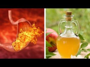 Read more about the article Apple Cider Vinegar… For Heartburn? Does It Work?