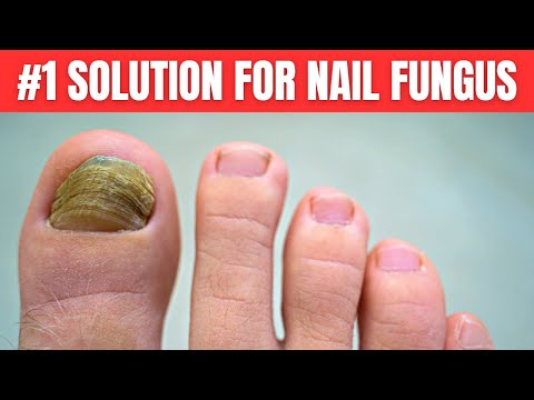 You are currently viewing You Need Only 2 Ingredients To Get Rid of Nail Fungus Completely