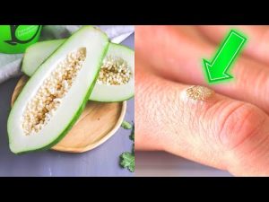 Read more about the article This Is How You Can Get Rid Of Warts For Good