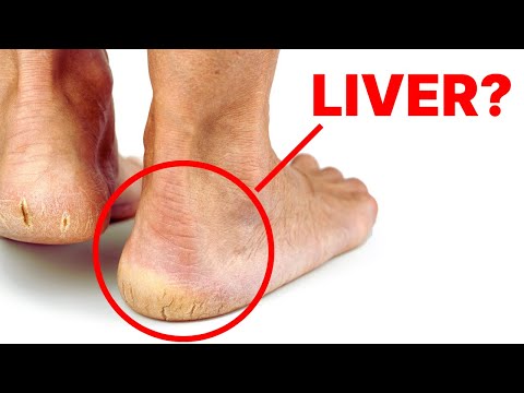 Read more about the article Is Your Liver Crying for Help? Check Your Feet for These Alarming Signs!