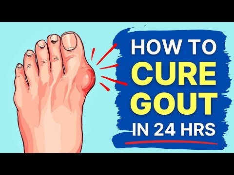 Read more about the article How to Heal Gout Naturally (Results in 24 hours!)