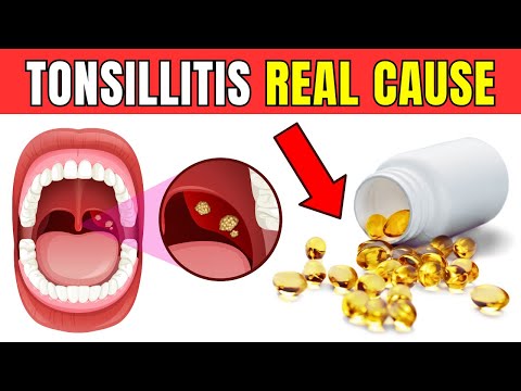 Read more about the article This is the REAL CAUSE of your recurring TONSILLITIS – it’s not what you think!