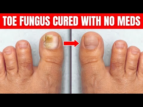 Read more about the article Toe Nail Fungus Cured With No Meds!