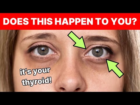 Read more about the article This Is How Thyroid Issues Begin and No One Tells You | Signs and Symptoms of Hypothyroidism