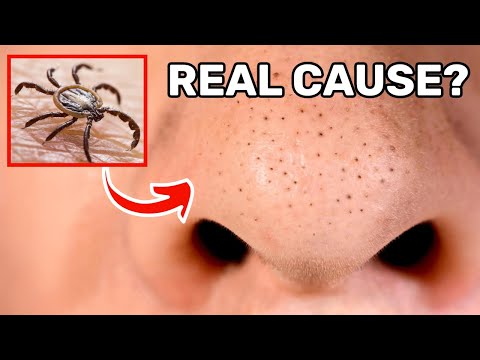 Read more about the article This is the Real Cause of Your Blackheads (and How to Get Rid of Them for Good!)